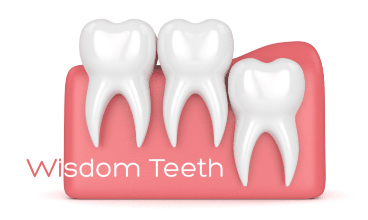 Wisdom Teeth Removal Milwaukee WI